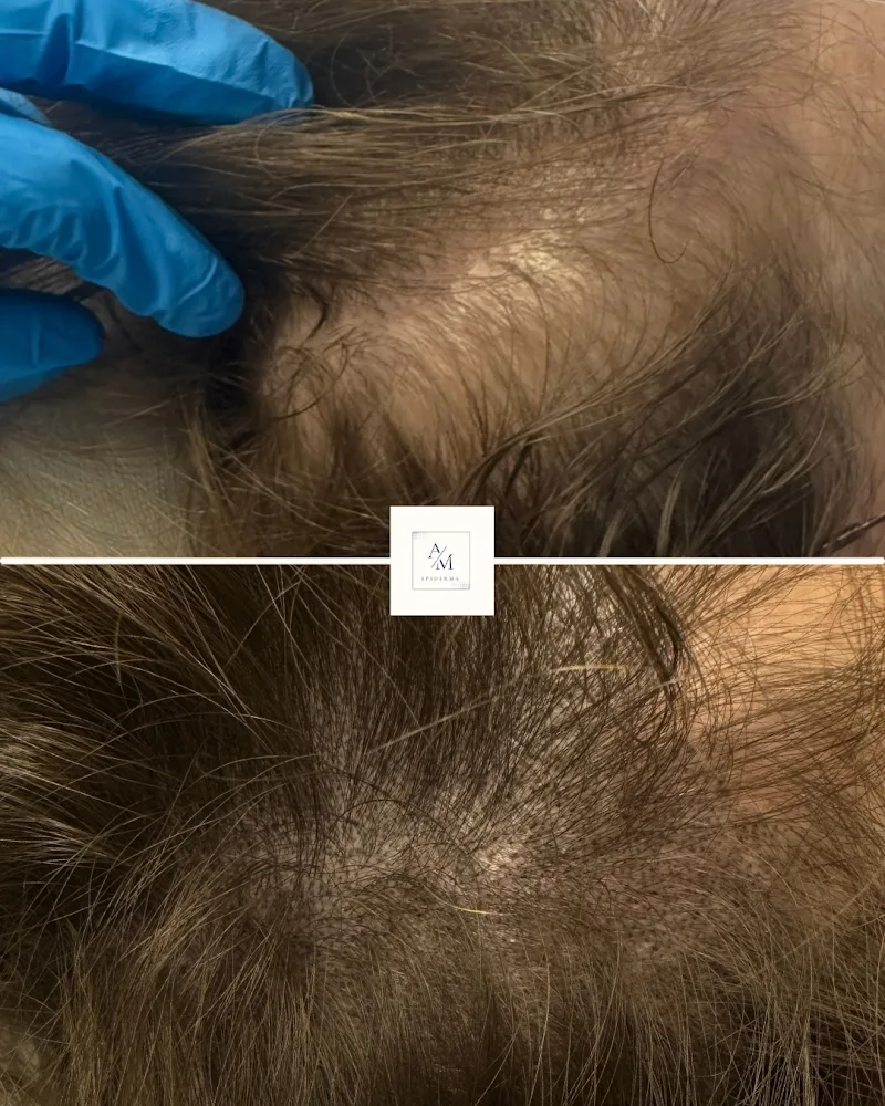AM EPIDERMA | Tricopigmentation à Orléans